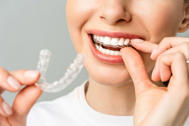 aligner_3.jpg 