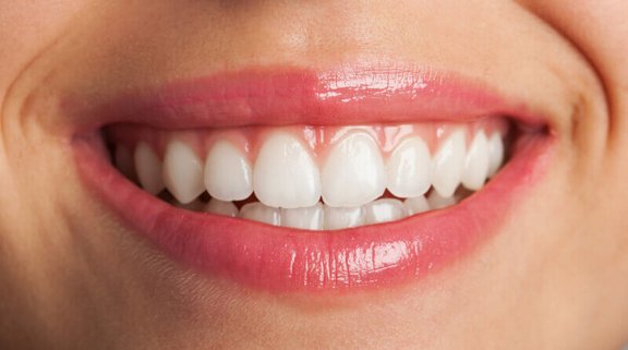 veneers.jpg